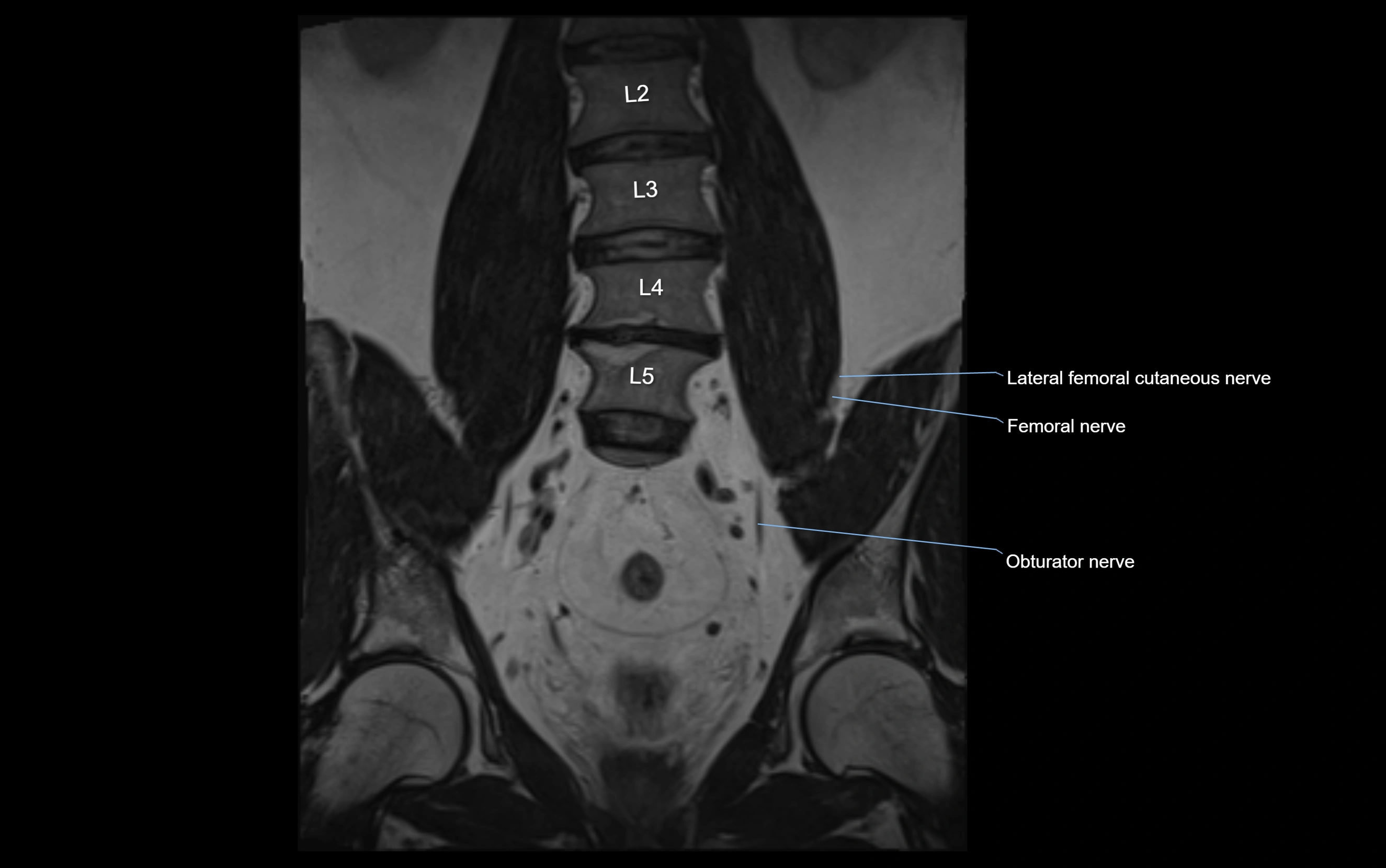 MR lumbosacral plexus cross sectional anatomy 3T  radiology  image-img-09001-00024.webp
